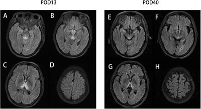 Case Report: Wernicke's encephalopathy after gastric surgery presenting as lactic acidosis and refractory thrombocytopenia